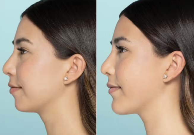 Facial Contouring Treatments