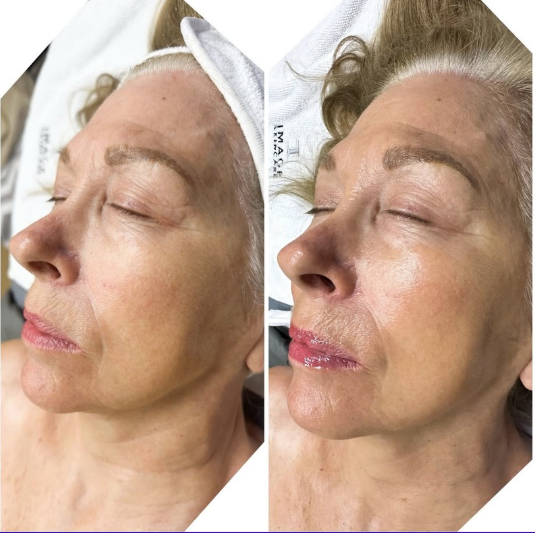 Ormedic lift facial treatment products