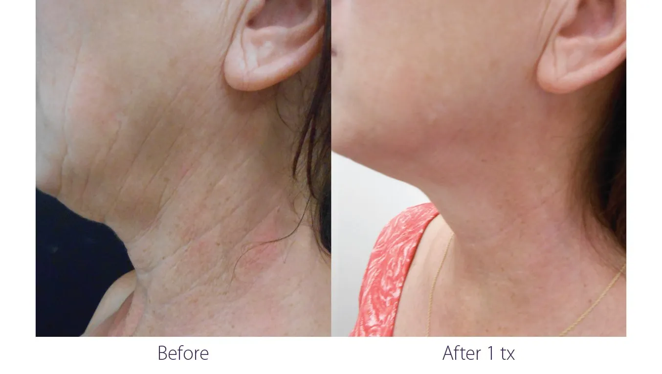 Opus Plasma Neck & Décolletage Treatment
