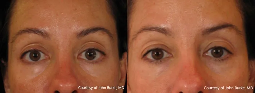 Pelleve Treatment in Progress